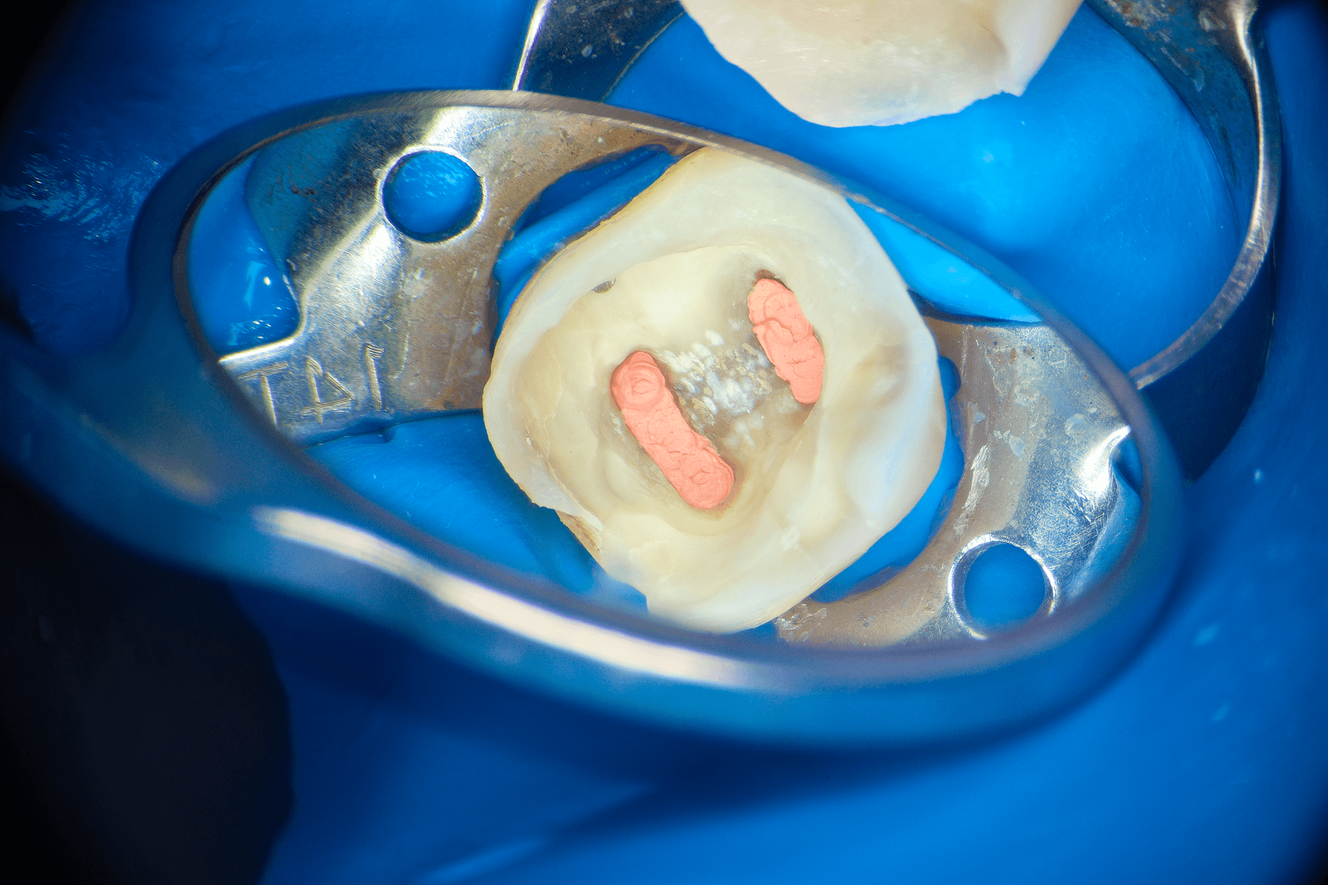 Dynamika procesu zamykania światła kanałów korzeniowych (PCO) oraz&nbsp;nowoczesne protokoły zabiegowe w&nbsp;obliteracjach z&nbsp;zastosowaniem laserów erbowych