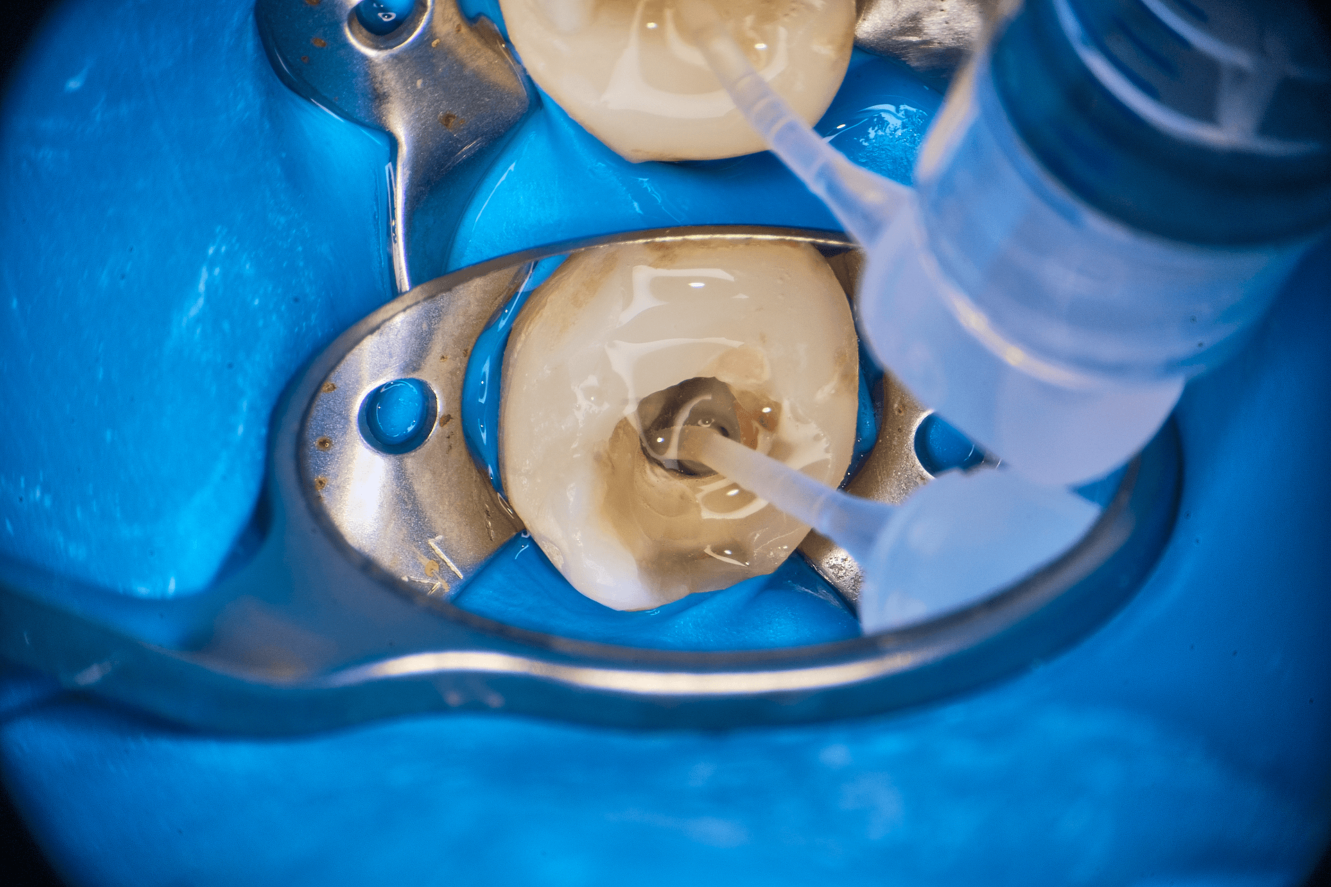 Podchloryn Sodu w&nbsp;Endodoncji: Analiza Mechanizmów Fizykochemicznych, Kinetyki i&nbsp;Protokółów Klinicznych