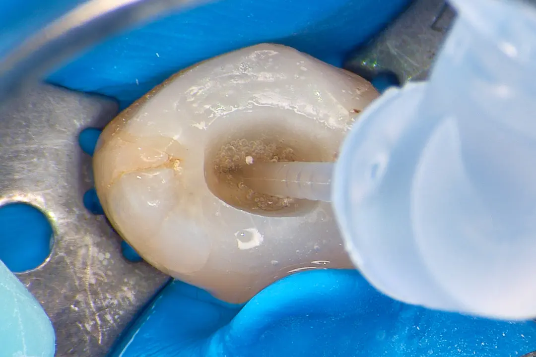 Penetracja płynów płuczących w&nbsp;kanaliki zębinowe – znaczenie kliniczne oraz&nbsp;wpływ technik aktywacji